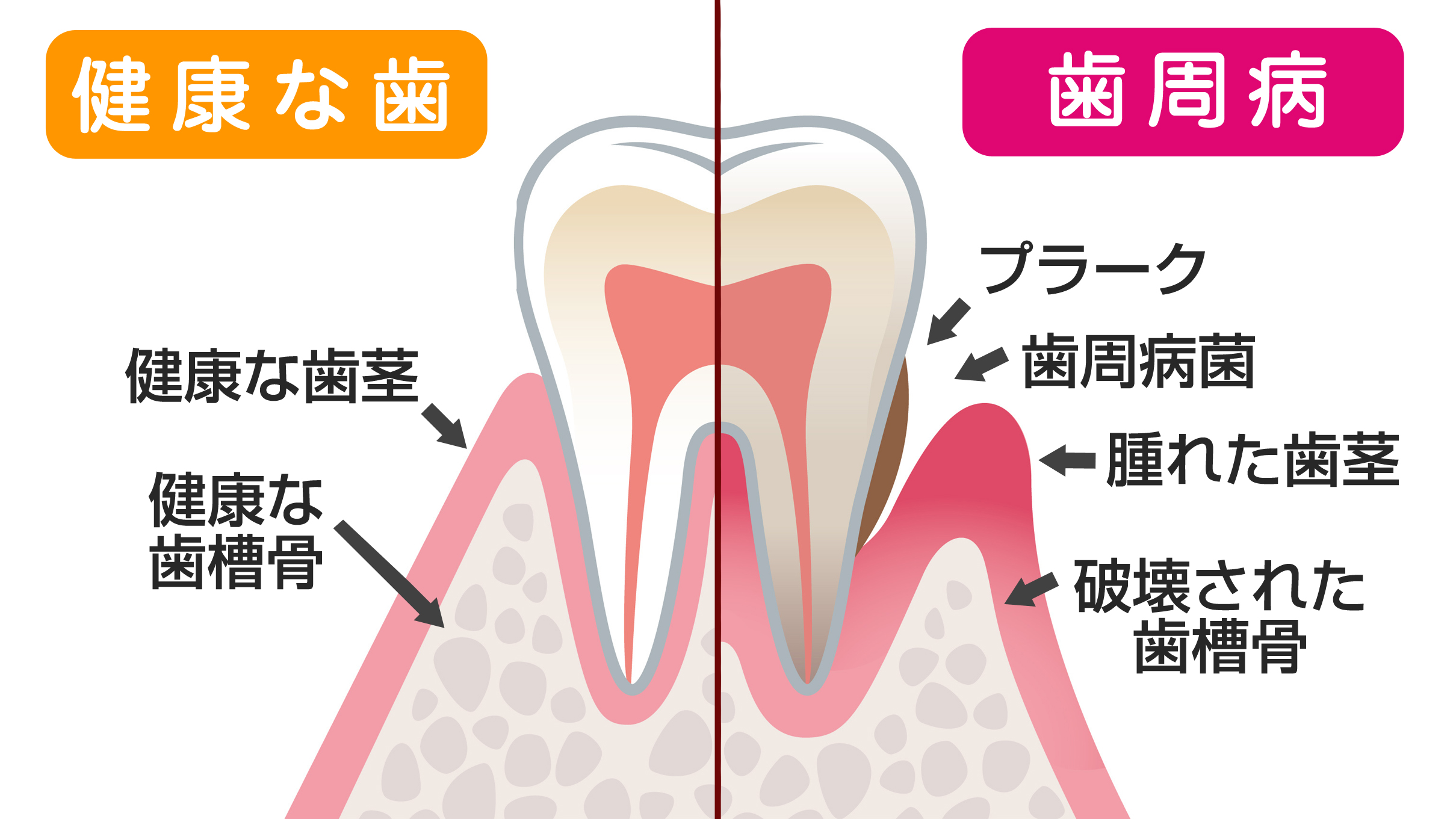 歯周病について