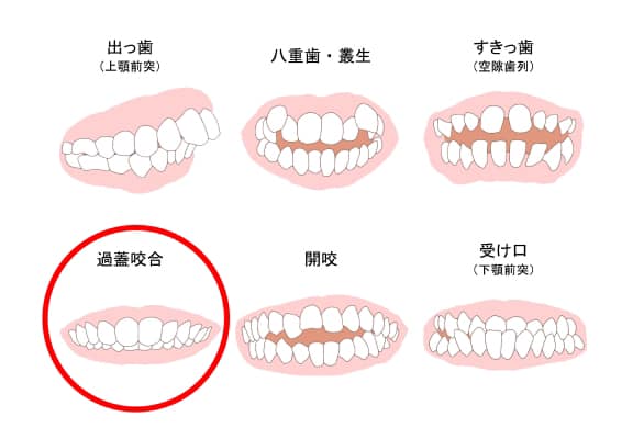 小児の口腔育成について