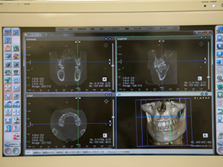 歯科用CT