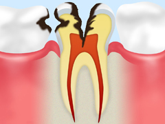 C3：神経の虫歯