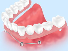 インプラントオーバーデンチャー