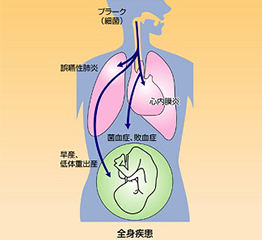 全身疾患にも関わる歯周病