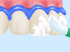 Step2：歯ぐきの保護と歯面への薬剤塗布